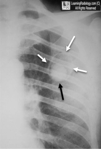 Aspergilloma